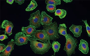 Betrachtung von mehrfach gefärbten alveolaren Krebszellen Typ I