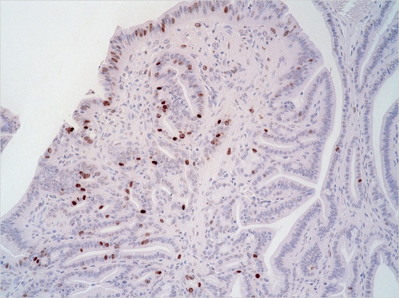 Bild: Krebszellen, die sich im Magengewebe vermehren