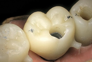 Betrachtung von Zahnimplantaten
